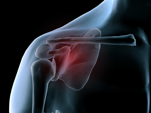 pinched_nerve_shoulder_surgery